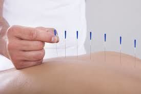 Acupuncture for Back Pain